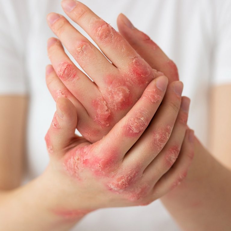 psoriasis